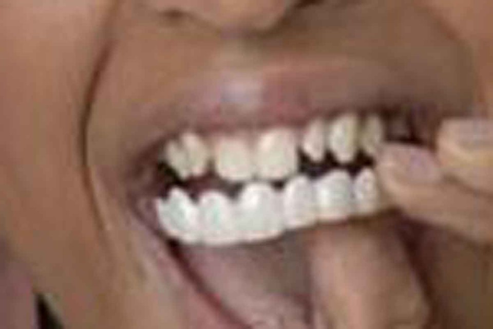Nieuwe trend: beugel tanden | Het Belang van Mobile