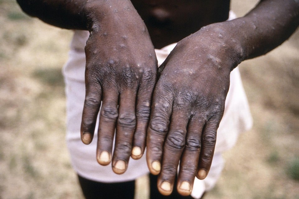  De handen van een patiënt met apenpokken tijdens een uitbraak in 1997 in de Democratische Republiek Congo.   