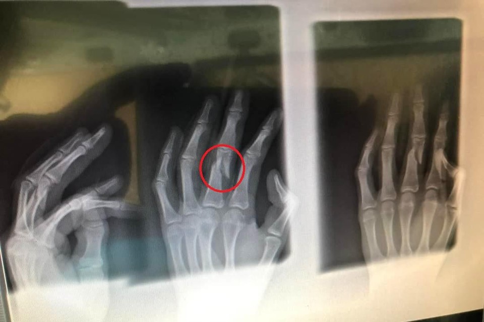 Op de röntgenfoto is de breuk in de middenvinger van Everts heel goed te zien. 