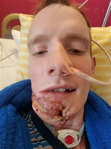 Lorenz (29) Uit Antwerpen Verliest Kaak Door Kanker: “Mensen Zijn Bang Van  Mij” (Antwerpen) | Het Belang Van Limburg Mobile